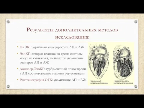 Результаты дополнительных методов исследования: На ЭКГ: признаки гипертрофии ЛП и ЛЖ