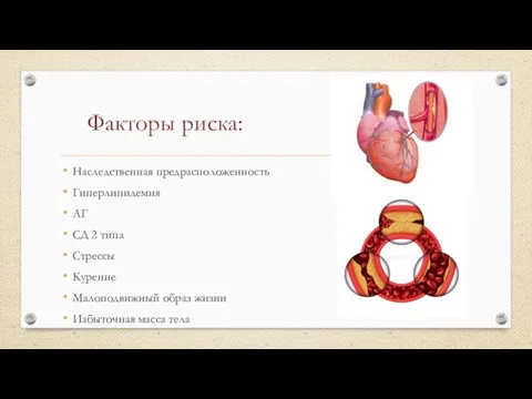 Факторы риска: Наследственная предрасположенность Гиперлипидемия АГ СД 2 типа Стрессы Курение