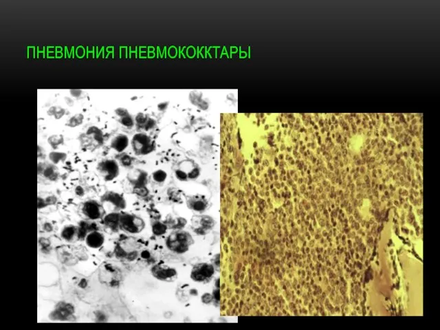 ПНЕВМОНИЯ ПНЕВМОКОККТАРЫ
