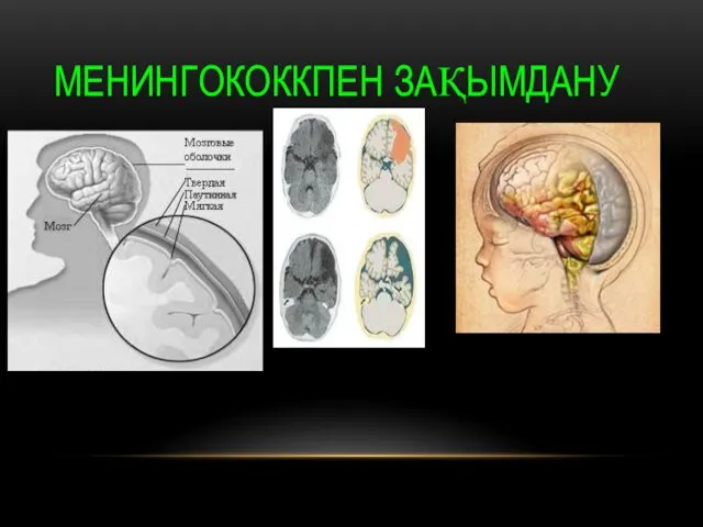 МЕНИНГОКОККПЕН ЗАҚЫМДАНУ