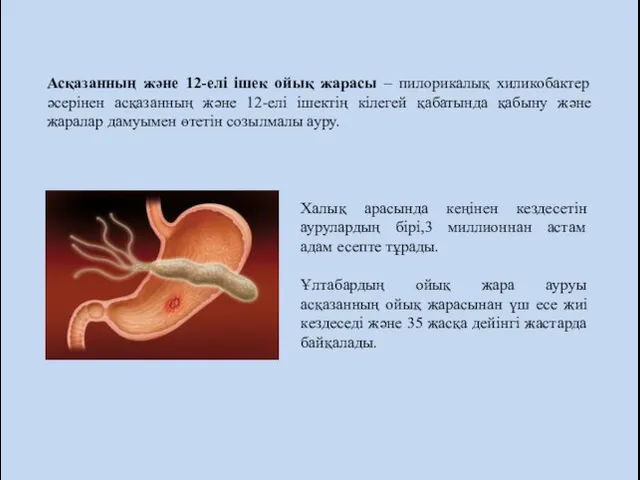 Асқазанның және 12-елі ішек ойық жарасы – пилорикалық хиликобактер әсерінен асқазанның