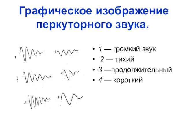 Графическое изображение перкуторного звука. 1 — громкий звук 2 — тихий 3 —продолжительный 4 — короткий