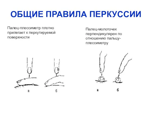 ОБЩИЕ ПРАВИЛА ПЕРКУССИИ Палец-плессиметр плотно прилегает к перкутируемой поверхности Палец-молоточек перпендикулярен по отношению пальцу-плессиметру