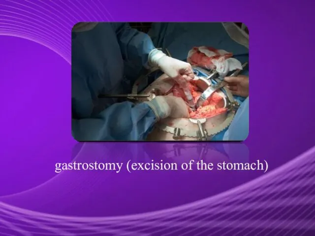 gastrostomy (excision of the stomach)