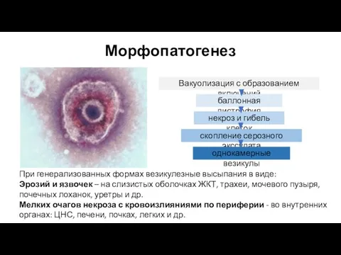 Морфопатогенез Вакуолизация с образованием включений баллонная дистрофия некроз и гибель клеток