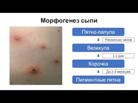 Морфогенез сыпи Корочка Пигментные пятна Везикула Пятно-папула Несколько часов До 2-3 месяцев 1-2 дня