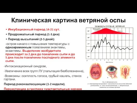 Клиническая картина ветряной оспы -Интоксикационный синдром, -Увеличение всех групп ЛУ (пальпация