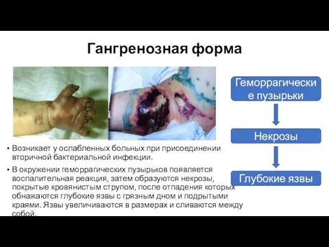 Гангренозная форма Возникает у ослабленных больных при присоединении вторичной бактериальной инфекции.