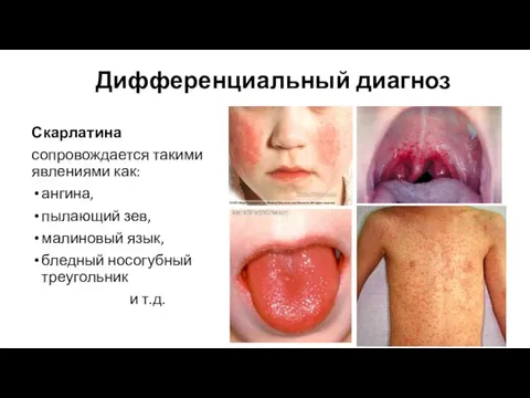 Дифференциальный диагноз Скарлатина сопровождается такими явлениями как: ангина, пылающий зев, малиновый