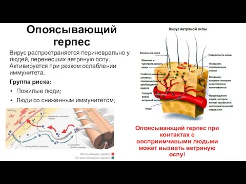 Опоясывающий герпес Вирус распространяется периневрально у людей, перенесших ветряную оспу. Активируется