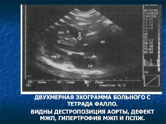 ДВУХМЕРНАЯ ЭХОГРАММА БОЛЬНОГО С ТЕТРАДА ФАЛЛО. ВИДНЫ ДЕСТРОПОЗИЦИЯ АОРТЫ, ДЕФЕКТ МЖП, ГИПЕРТРОФИЯ МЖП И ПСПЖ.