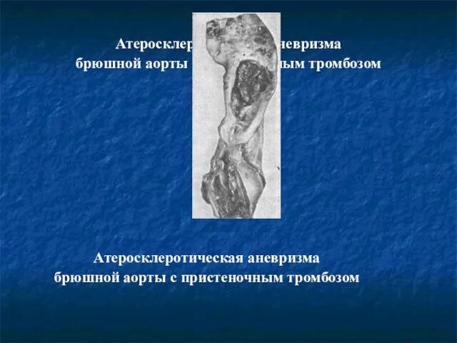 Атеросклеротическая аневризма брюшной аорты с пристеночным тромбозом Атеросклеротическая аневризма брюшной аорты с пристеночным тромбозом