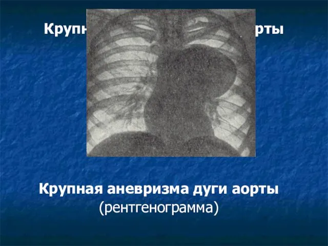 Крупная аневризма дуги аорты (рентгенограмма) Крупная аневризма дуги аорты (рентгенограмма)