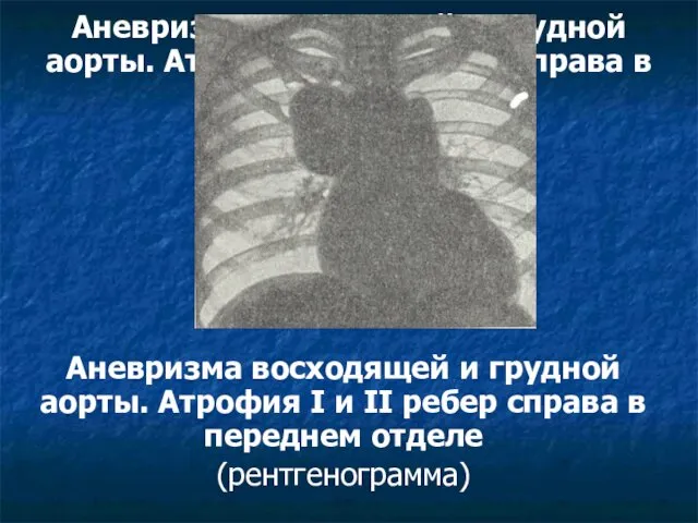 Аневризма восходящей и грудной аорты. Атрофия I и II ребер справа
