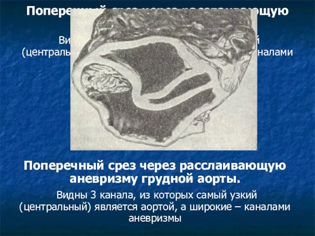 Поперечный срез через расслаивающую аневризму грудной аорты. Видны 3 канала, из