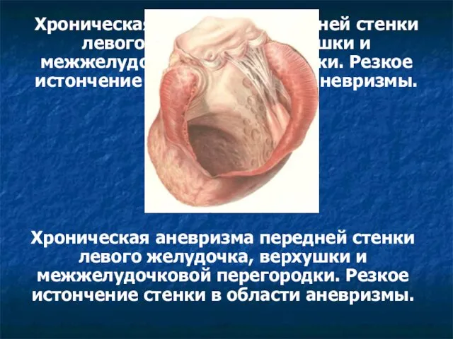 Хроническая аневризма передней стенки левого желудочка, верхушки и межжелудочковой перегородки. Резкое