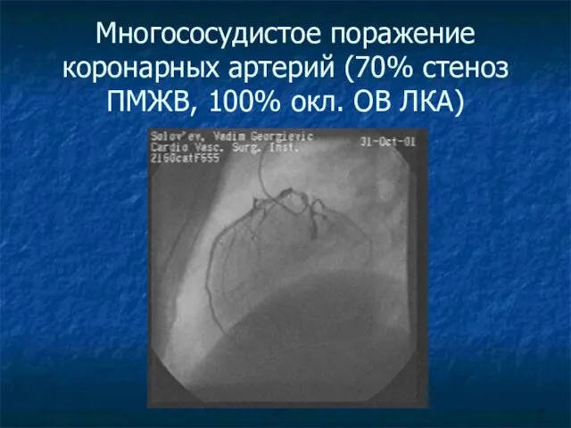 Многососудистое поражение коронарных артерий (70% стеноз ПМЖВ, 100% окл. ОВ ЛКА)