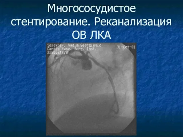 Многососудистое стентирование. Реканализация ОВ ЛКА