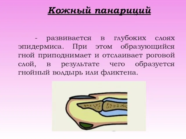 Кожный панариций - развивается в глубоких слоях эпидермиса. При этом образующийся