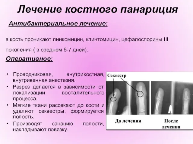 Лечение костного панариция Антибактериальное лечение: в кость проникают линкомицин, клинтомицин, цефалоспорины