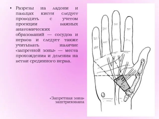 Разрезы на ладони и пальцах кисти следует проводить с учетом проекции