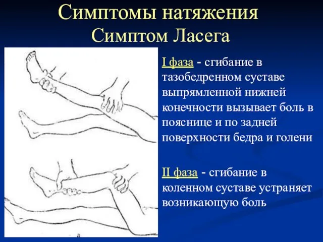 Симптом Ласега I фаза - сгибание в тазобедренном суставе выпрямленной нижней