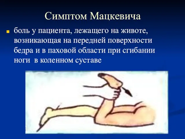 Симптом Мацкевича боль у пациента, лежащего на животе, возникающая на передней