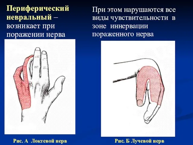 При этом нарушаются все виды чувствительности в зоне иннервации пораженного нерва