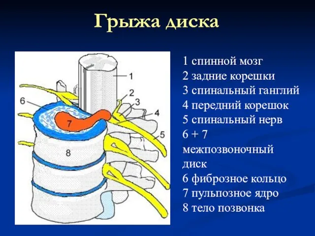 Грыжа диска 1 спинной мозг 2 задние корешки 3 спинальный ганглий