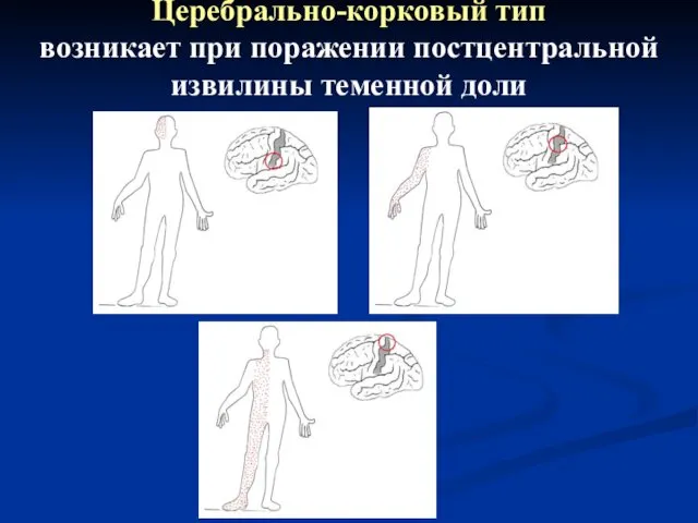 Церебрально-корковый тип возникает при поражении постцентральной извилины теменной доли