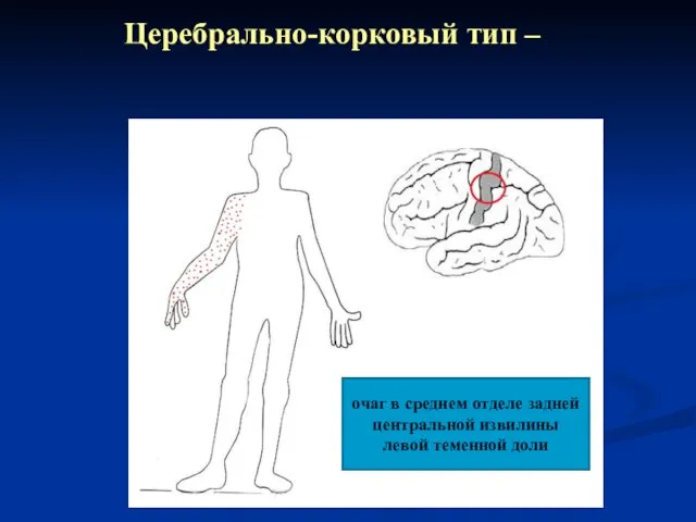 Церебрально-корковый тип – очаг в среднем отделе задней центральной извилины левой теменной доли