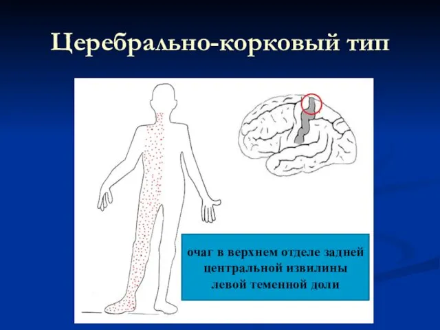 Церебрально-корковый тип очаг в верхнем отделе задней центральной извилины левой теменной доли