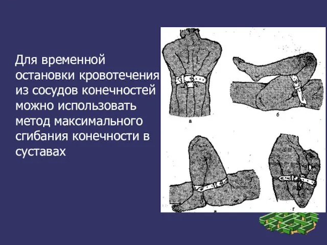 Для временной остановки кровотечения из сосудов конечностей можно использовать метод максимального сгибания конечности в суставах