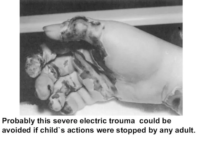 Probably this severe electric trouma could be avoided if child`s actions were stopped by any adult.