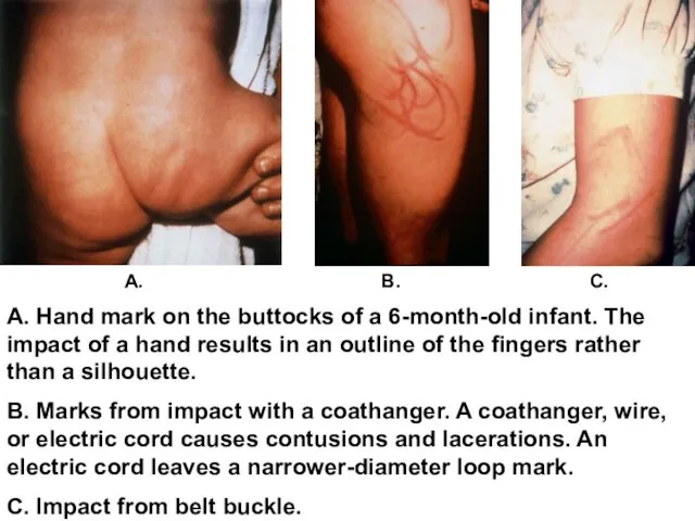 А. Hand mark on the buttocks of a 6-month-old infant. The