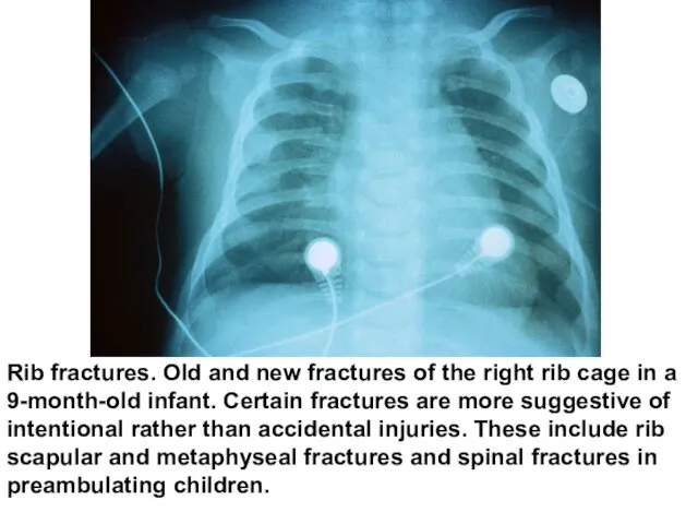 Rib fractures. Old and new fractures of the right rib cage