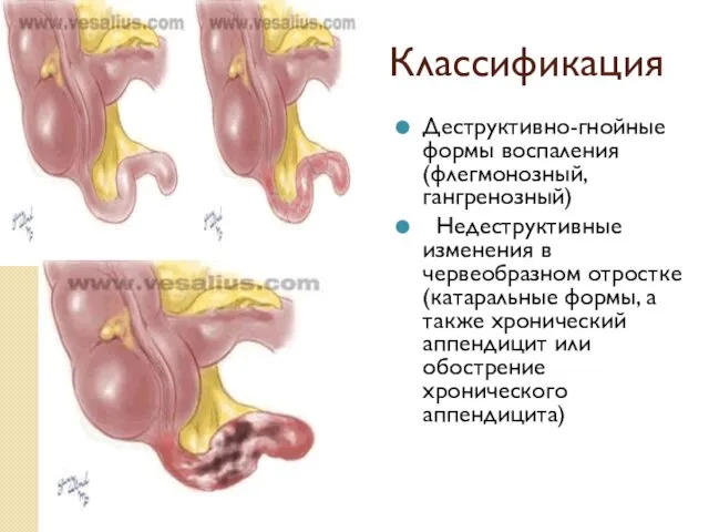 Классификация Деструктивно-гнойные формы воспаления (флегмонозный, гангренозный) Недеструктивные изменения в червеобразном отростке