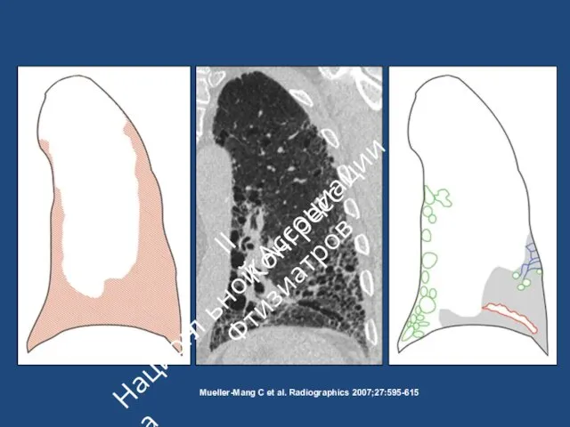 Mueller-Mang C et al. Radiographics 2007;27:595-615 II Конгресс ьной Ассоциации Фтизиатров Национа л