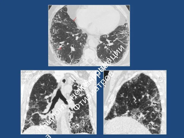 II Конгресс ьной Ассоциации Фтизиатров Национа л