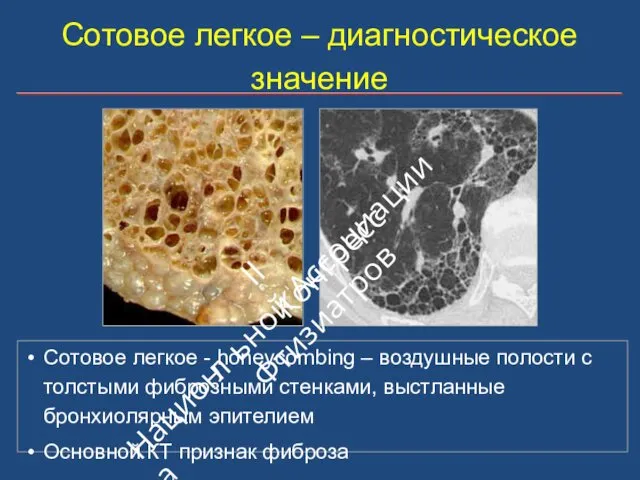 Сотовое легкое – диагностическое значение Сотовое легкое - honeycombing – воздушные