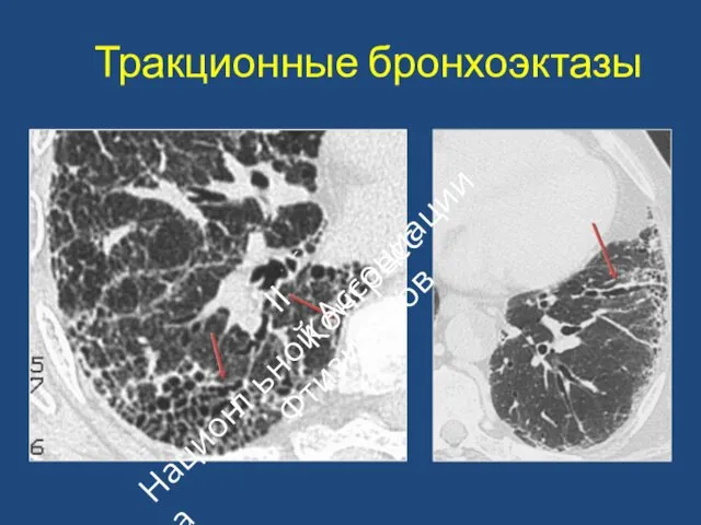 Тракционные бронхоэктазы II Конгресс ьной Ассоциации Фтизиатров Национа л