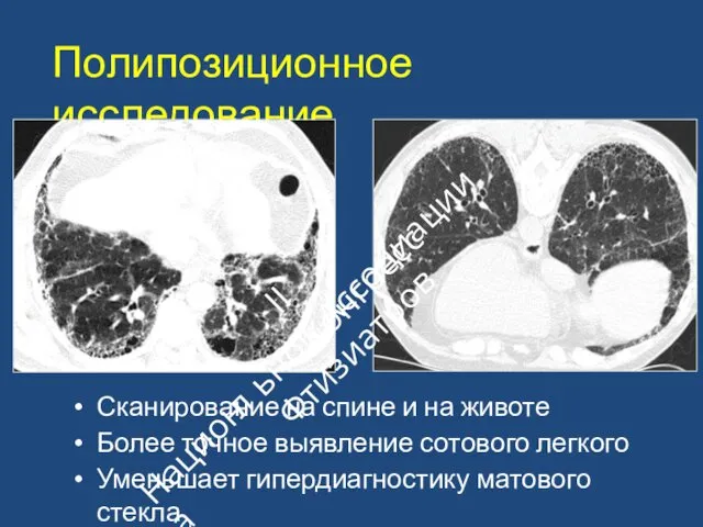 Полипозиционное исследование Сканирование на спине и на животе Более точное выявление