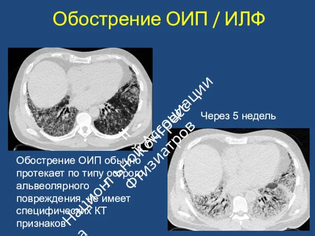 Обострение ОИП / ИЛФ Через 5 недель Обострение ОИП обычно протекает