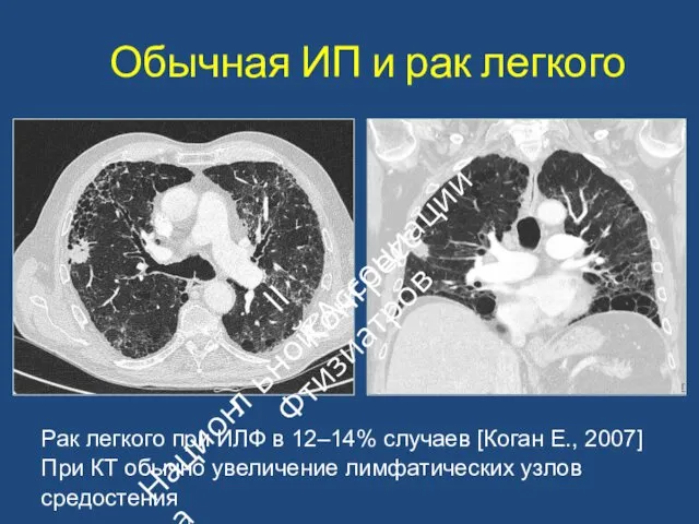 Обычная ИП и рак легкого Рак легкого при ИЛФ в 12–14%