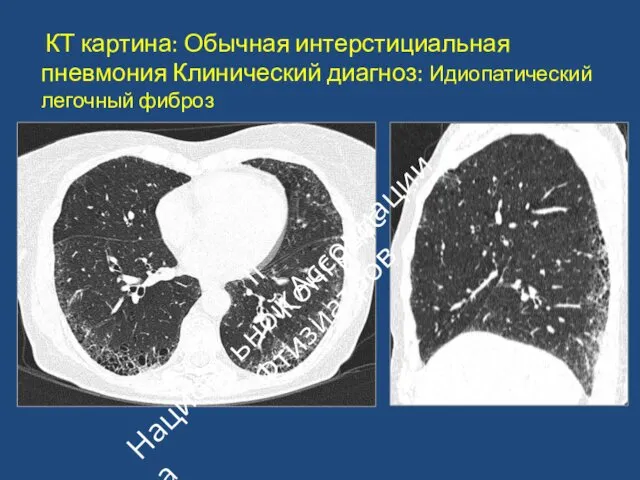 КТ картина: Обычная интерстициальная пневмония Клинический диагноз: Идиопатический легочный фиброз II