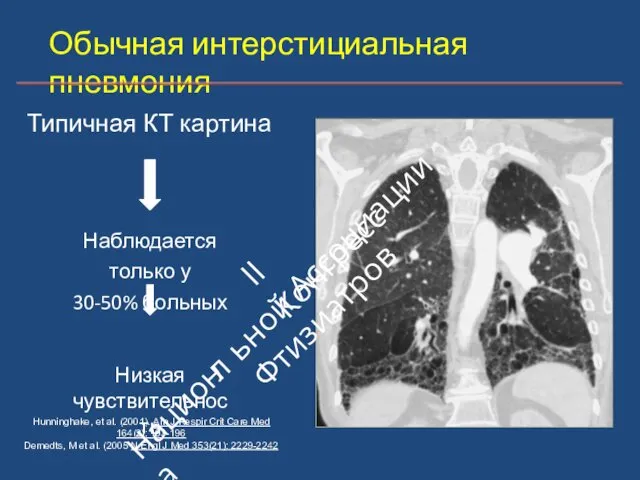 Обычная интерстициальная пневмония Наблюдается только у 30‐50% больных Низкая чувствительность Hunninghake,