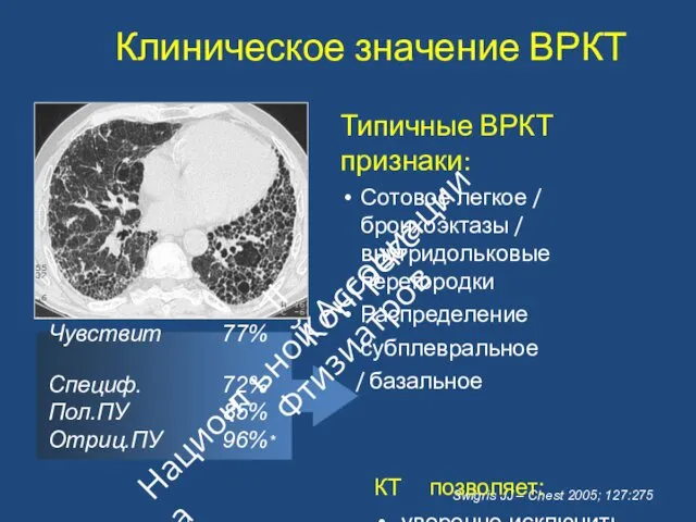 Swigris JJ – Chest 2005; 127:275 Типичные ВРКТ признаки: Сотовое легкое