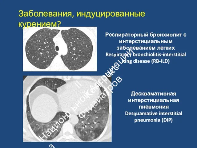 Респираторный бронхиолит с интерстициальным заболеванием легких Respiratory bronchiolitis‐interstitial lung disease (RB‐ILD)