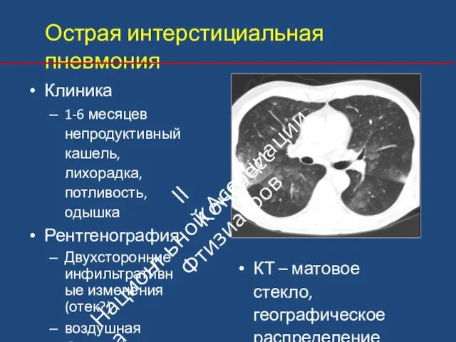 Острая интерстициальная пневмония Клиника 1‐6 месяцев непродуктивный кашель, лихорадка, потливость, одышка