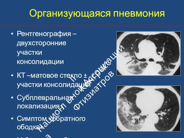 Организующаяся пневмония Рентгенография – двухсторонние участки консолидации КТ –матовое стекло ±